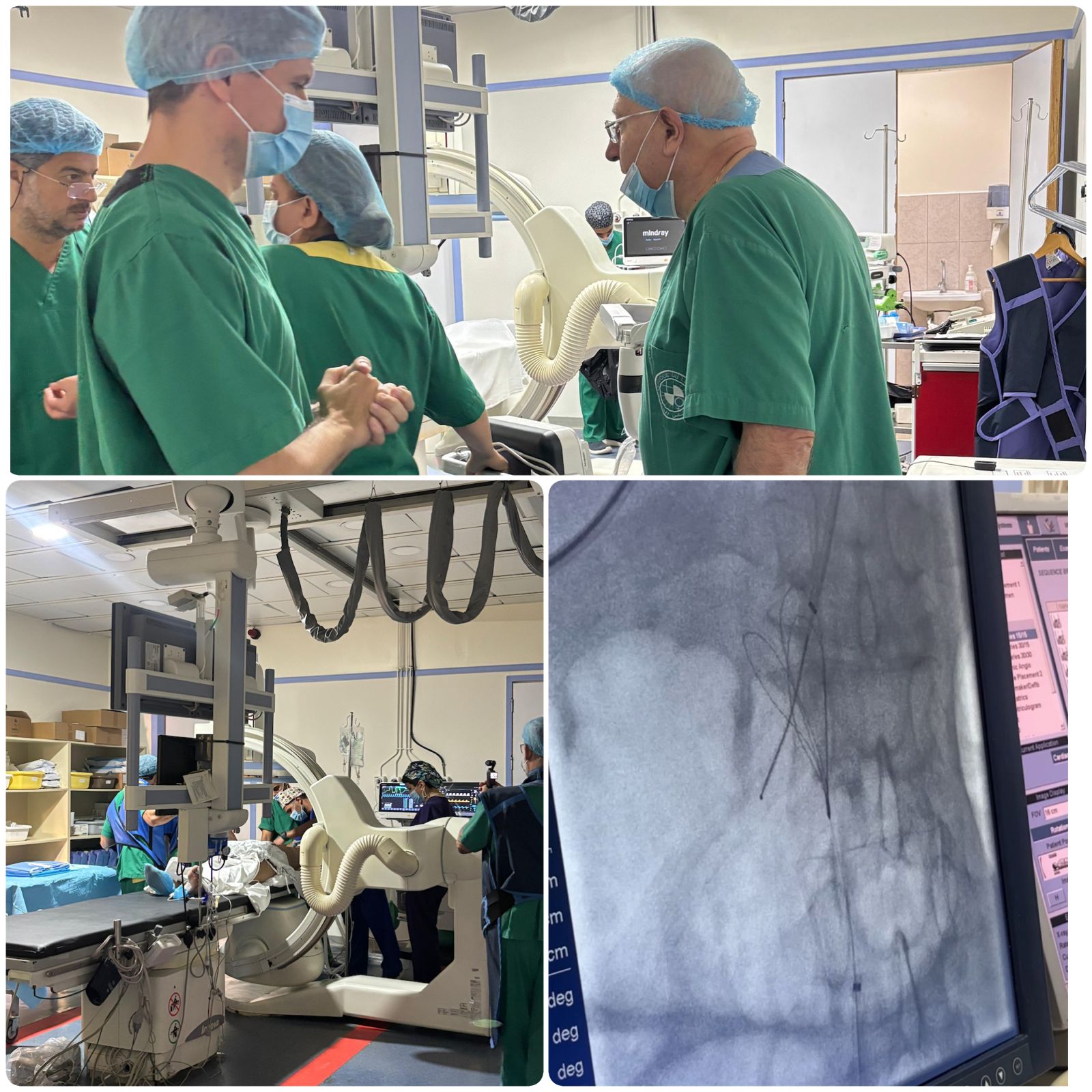 مستشفى المشرق يحقق إنجازًا طبيًا تاريخيًا: أول عملية TIPS معكوسة لانسداد الأوعية الكبدية والوريد البابي 1 1 3732