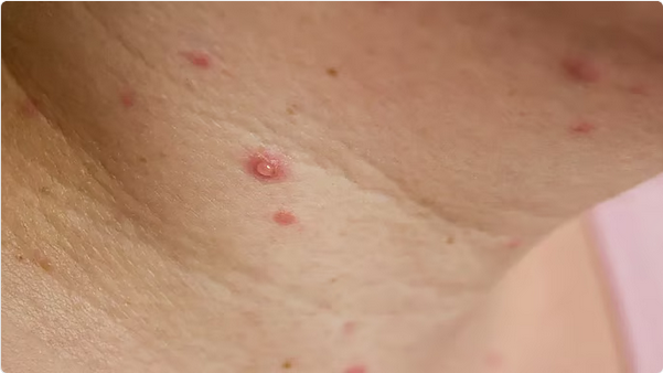 برلين تسجّل أول إصابة بجدري القرود "إمبوكس" من الفئة "1ب" 1 10 2 9