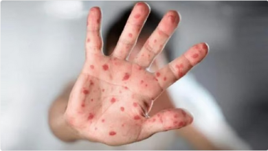 تايلاند تسجل 40 إصابة بجدري القرود خلال 2025 5 2 259