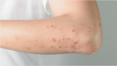 علامات جلدية تحذيرية: كيف يكشف الطفح الجلدي عن أمراض الكبد والمناعة؟ 6 3 279