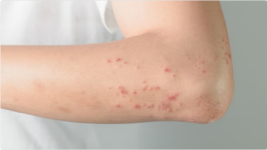 علامات جلدية تحذيرية: كيف يكشف الطفح الجلدي عن أمراض الكبد والمناعة؟ 1 3 279