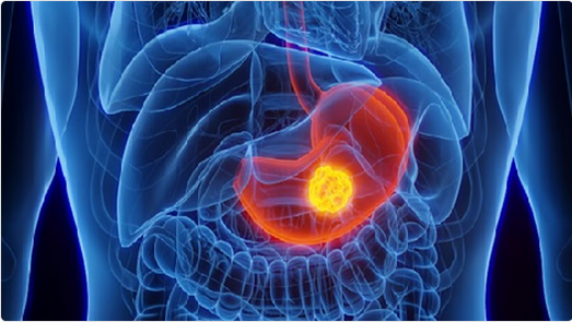 دراسة عالمية تُحذّر: بكتيريا "H. pylori" تُهدد الملايين بسرطان المعدة.. والفحص المبكر هو الحل! 1 33 94