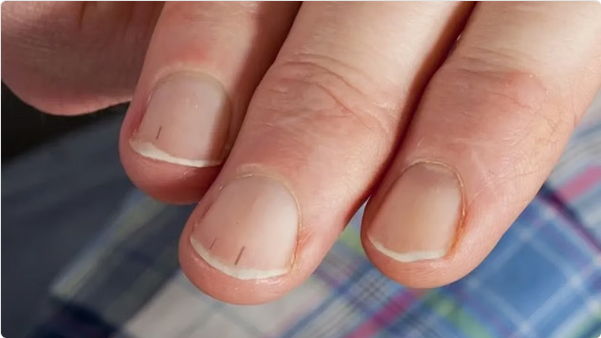 الأظافر تكشف أسرار القلب: علامات خفية تنبئ بأمراض خطيرة 1 666 78