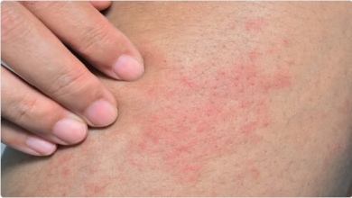 تجمع القصيم الصحي يحذر: ارتفاع درجات الحرارة ينذر بانتشار الطفح الجلدي الحراري 4 77 94