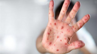 ناقوس خطر في الأمريكتين: قفزة قياسية لإصابات الحصبة بزيادة 43 ضعفاً وتنبيه وبائي عاجل 15 7777 86