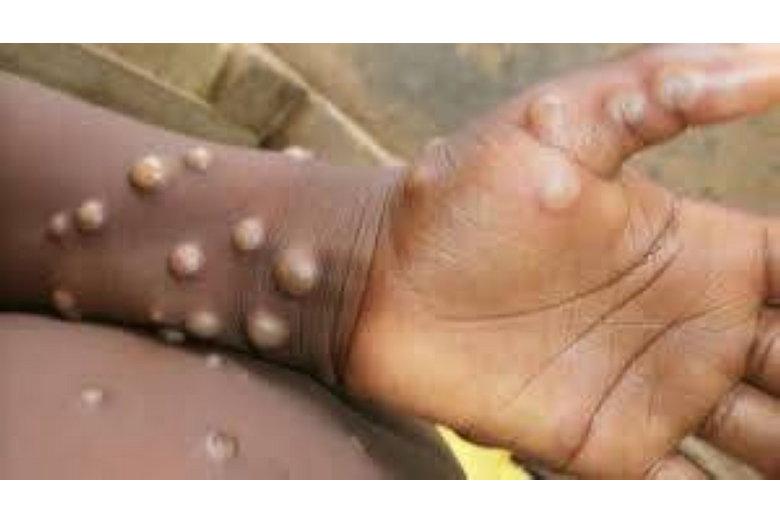 إنجاز طبي في أفريقيا: انخفاض كبير في حالات جدري القرود بفضل جهود الفحص 1 9 405