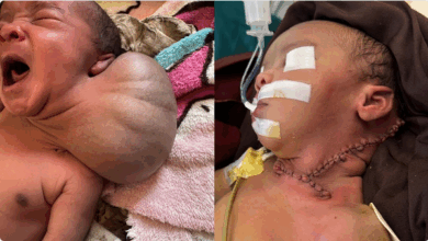 فريق طبي ينقذ حياة رضيع في الصومال الإثيوبي من تشوه نادر 3 99 2 4