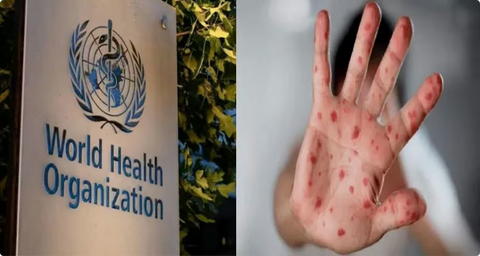 طفرة جينية هجينة.. رصد سلالة جديدة من "جدري القرود" تجمع بين متحورين في بريطانيا والهند 1 999 2 30