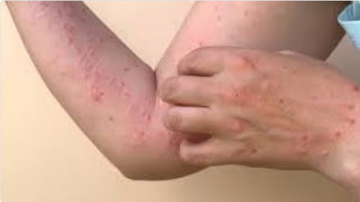 تسجيل أول إصابة بسلالة جديدة من جدري القردة في نيويورك 1 9999 91