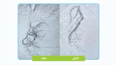 تقنية تداخلية تنهي معاناة مريضة من تغدد الرحم دون جراحة 1 WhatsApp Image 2026 05 07 at 5.41.41 PM