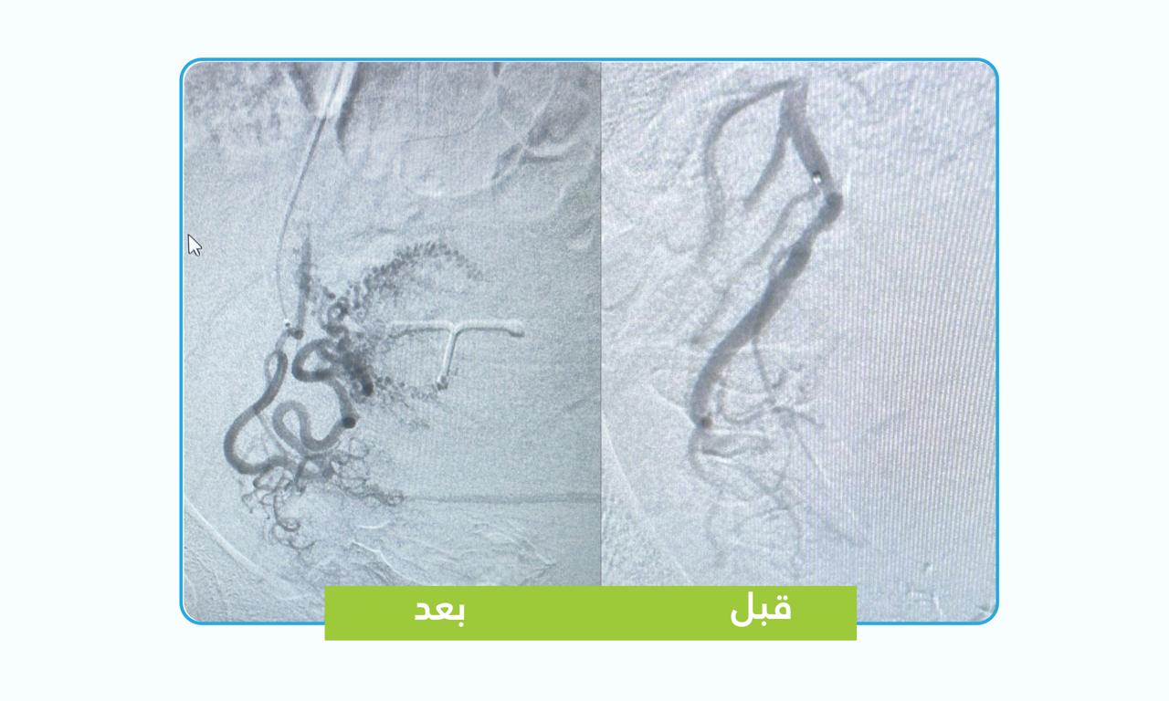 تقنية تداخلية تنهي معاناة مريضة من تغدد الرحم دون جراحة 1 WhatsApp Image 2026 05 07 at 5.41.41 PM